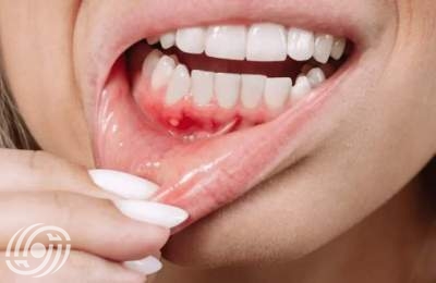 ما الذي يسبب "خرّاج" الأسنان؟ ما الذي يسبب "خرّاج" الأسنان؟
