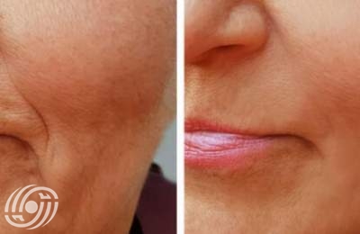 ما هو الكولاجين ولماذا هو مهم لصحة الجلد؟